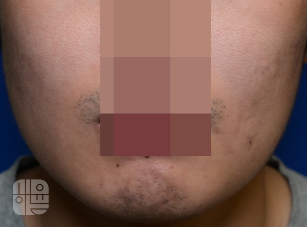 [목동점] 여드름흉터 치료 후 사진 - 해율한의원